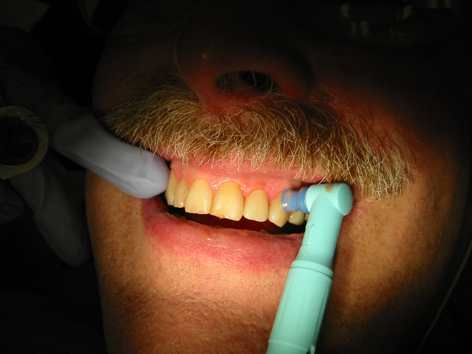 Tooth polishing Description: Dental hygienist polishing a patient's teeth during a periodic tooth cleaning. Viewpoint location: Seattle, Washington Date and time: 2006.01.18 10:48:09 PST Camera: Canon PowerShot S110 Photographer: Walter Siegmund ©2006 Walter Siegmund
